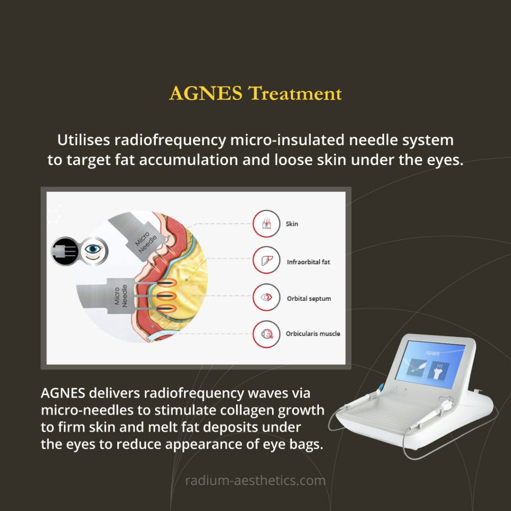 TOP 10 CLINICS FOR NONSURGICAL EYE BAG & UNDER EYE TREATMENTS IN SINGAPORE! Shout